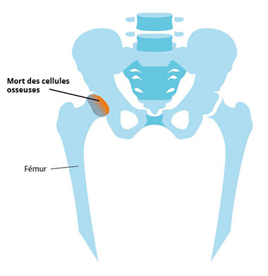 pathologie Ostéonécrose expliquée en schéma : mort des cellules osseuses proches du fémur