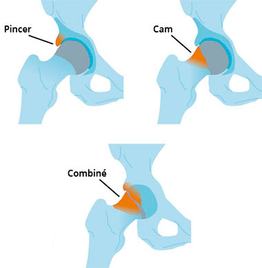 Schema en 3 étapes d'un conflit fémoro acétabulaire : pincer, cam et combiné