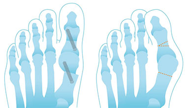 Schéma de l'opération hallux valgus du pied