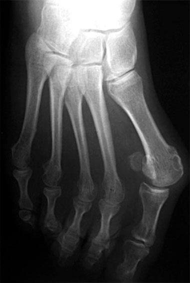 Radio d'un hallux valgus