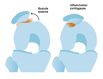 Schéma d'une instabilité rotulienne au genou, bascule externe et inflammation cartilageuse