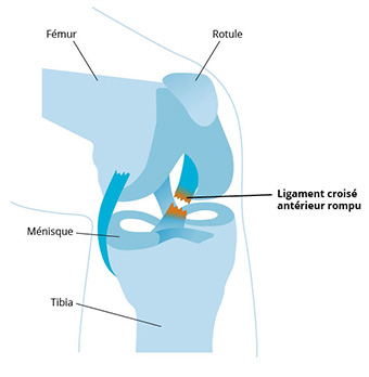 Instabilité ligamentaire au genou due à une rupture du ligament croisé