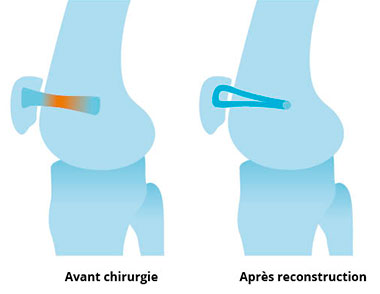 Schema avant/après d'une ligamentoplastie du MPFL