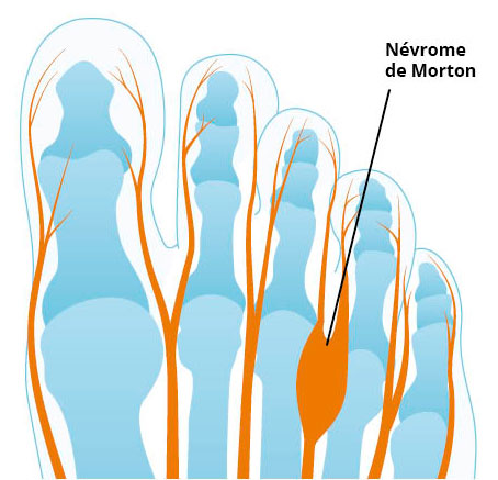 Schéma du névrome de Morton