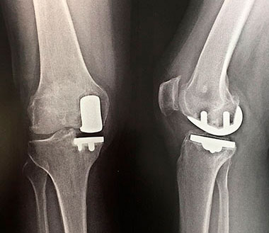 Prothèse de genou vue de face et de profil, descriptif du traitement